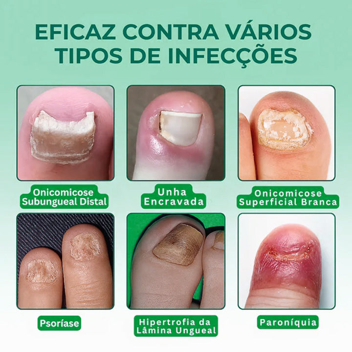 O único adesivo antifúngico que elimina fungos imediatamente - NutriNail®