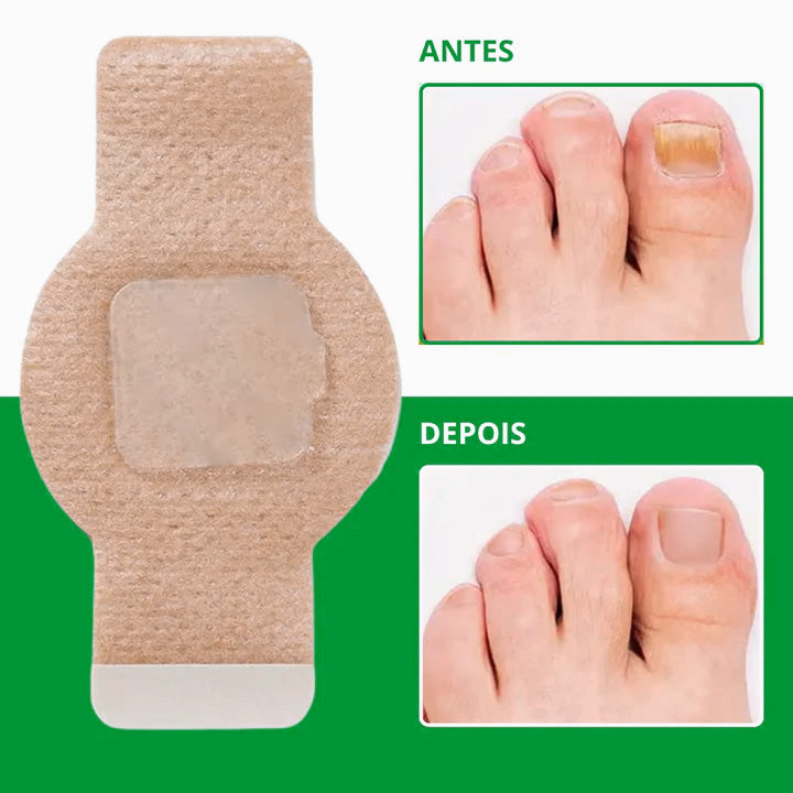 O único adesivo antifúngico que elimina fungos imediatamente - NutriNail®