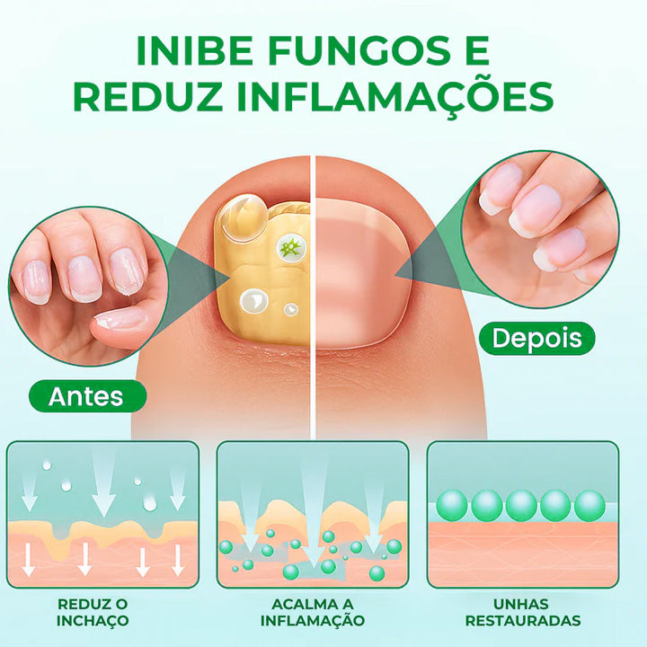 O único adesivo antifúngico que elimina fungos imediatamente - NutriNail®