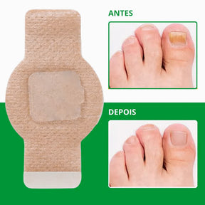O único adesivo antifúngico que elimina fungos imediatamente - NutriNail®